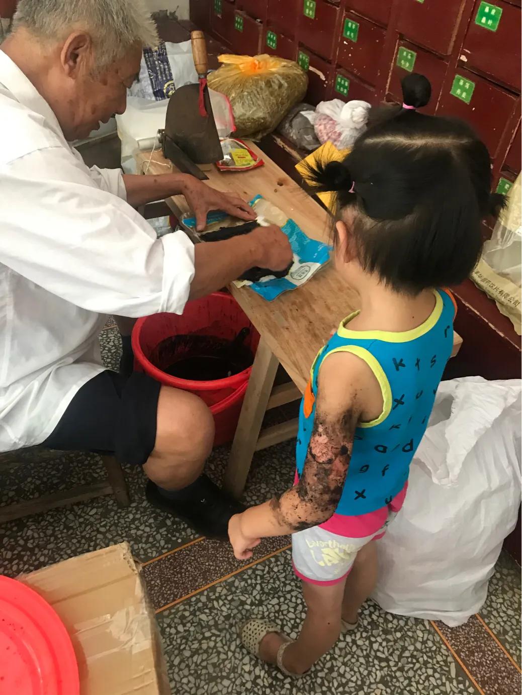 孩子大面积烫伤治疗流程,记录女儿被烫伤到治疗全过程