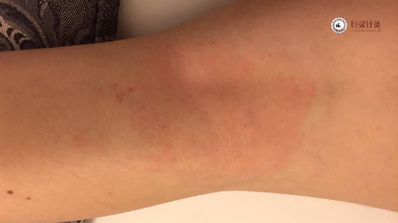 成人湿疹的特效穴,顽固性湿疹的特效穴