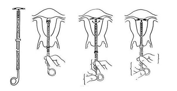 取环该做哪些准备,取环后多久可以备孕二胎