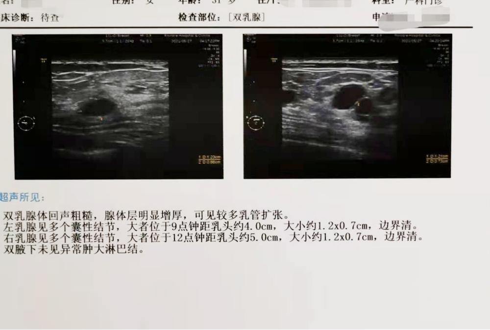 哺乳期乳房疙疙瘩瘩的,哺乳期乳房有疙瘩影响乳汁吗