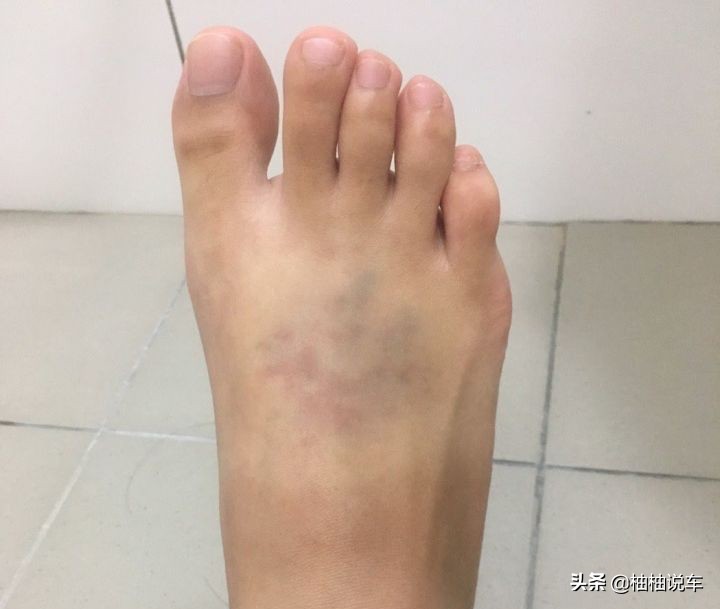 小孩被车压到脚上有什么后遗症,汽车车轮从脚上压过去会怎么样