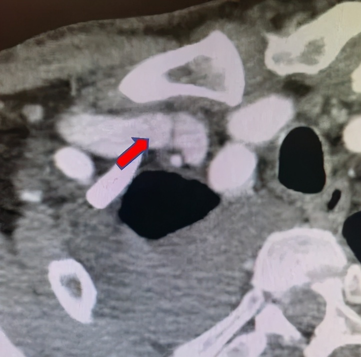 dsa食管狭窄球囊扩张术,经皮静脉超声引导下球囊扩张术