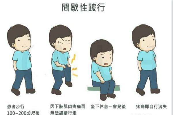 椎管狭窄引起的间歇性跛行怎么治,椎管狭窄间歇性跛行如何迅速恢复