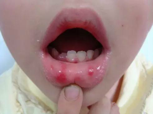 最近中招手足口病的宝宝,手足口病夏季高发几岁常见