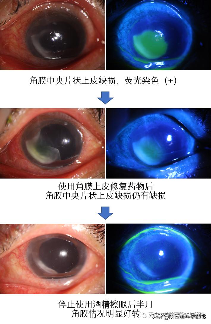 手术后伤口消毒用酒精还是碘伏,眼睛做了手术后可以用碘伏消毒么
