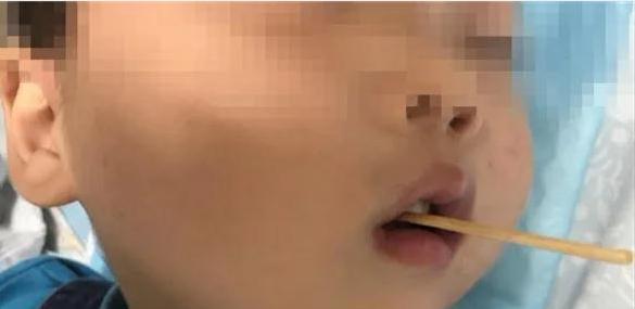浙江小男孩吃零食时竹签扎进脑干,2岁男孩惨遭异物穿刺头颅
