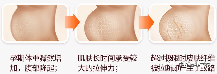 屁股妊娠纹怎么避免,男生妊娠纹如何避免