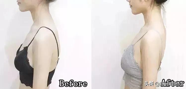 瘦拜拜肉和副乳最快的方法,瘦背和副乳赘肉最有效的方法