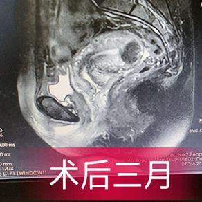 消除子宫肌瘤的特效药,消除子宫肌瘤最好中药