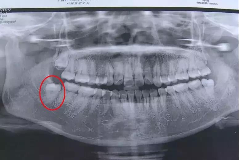 拔了一颗智齿花了1300元贵吗,拔个智齿花了800