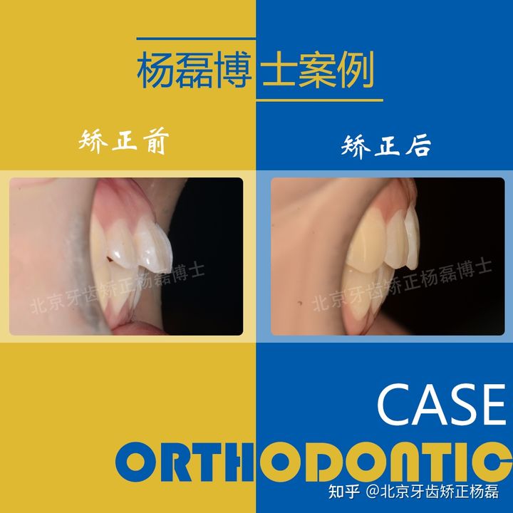 北京牙齿深覆合矫正推荐,重度拥挤牙齿矫正案例不拔牙