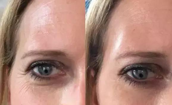 补水保湿淡化黑眼圈眼袋,黑眼袋黑眼圈用什么护肤品消除