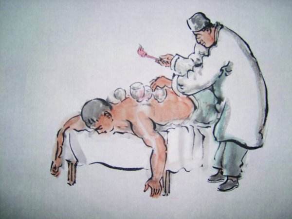 拔罐的知识与视频解说,拔罐后的罐印代表什么你知道吗