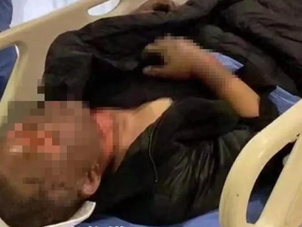 手机爆炸炸伤人严重事故,手机爆炸烧伤事件