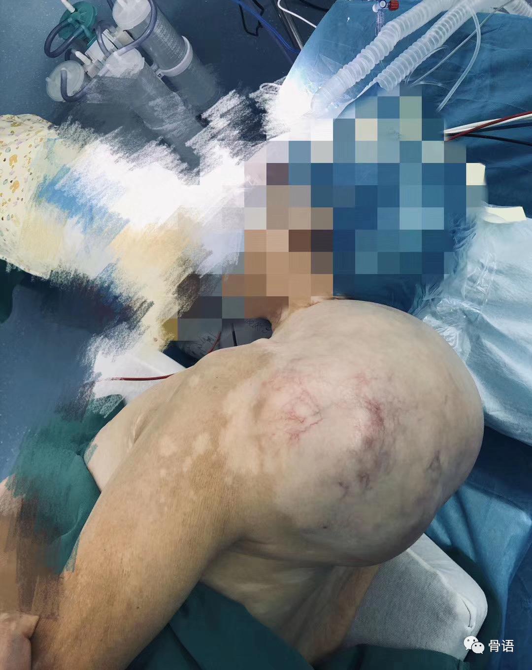 骨科恶性肿瘤,骨科软组织肉瘤是什么意思