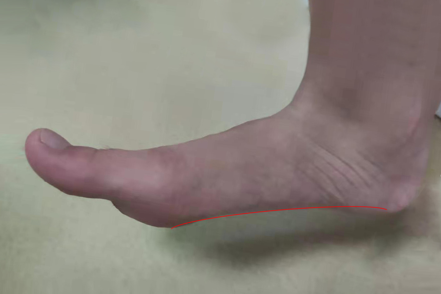 扁平足如何影响体态,扁平足会影响长高吗