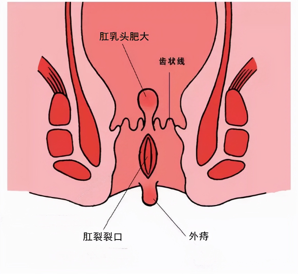 “菊花”不适，不一定都是“痔疮”的锅