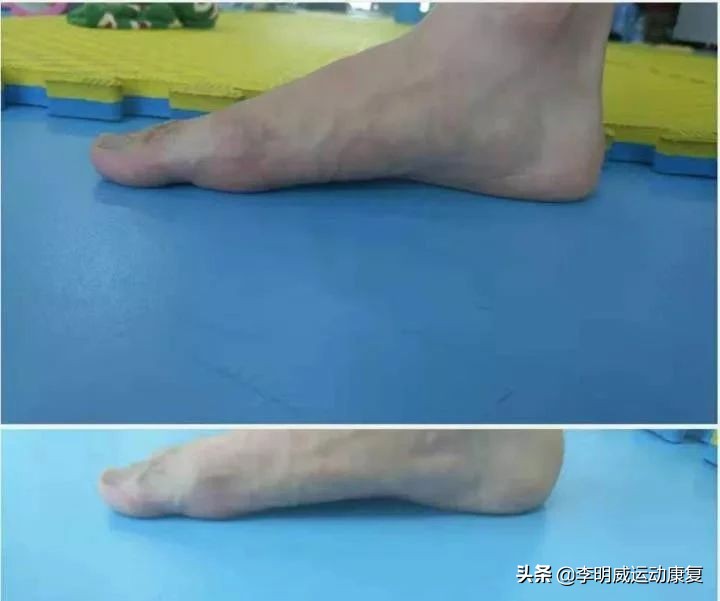 足外翻能不能治愈,足外翻能自己长好吗