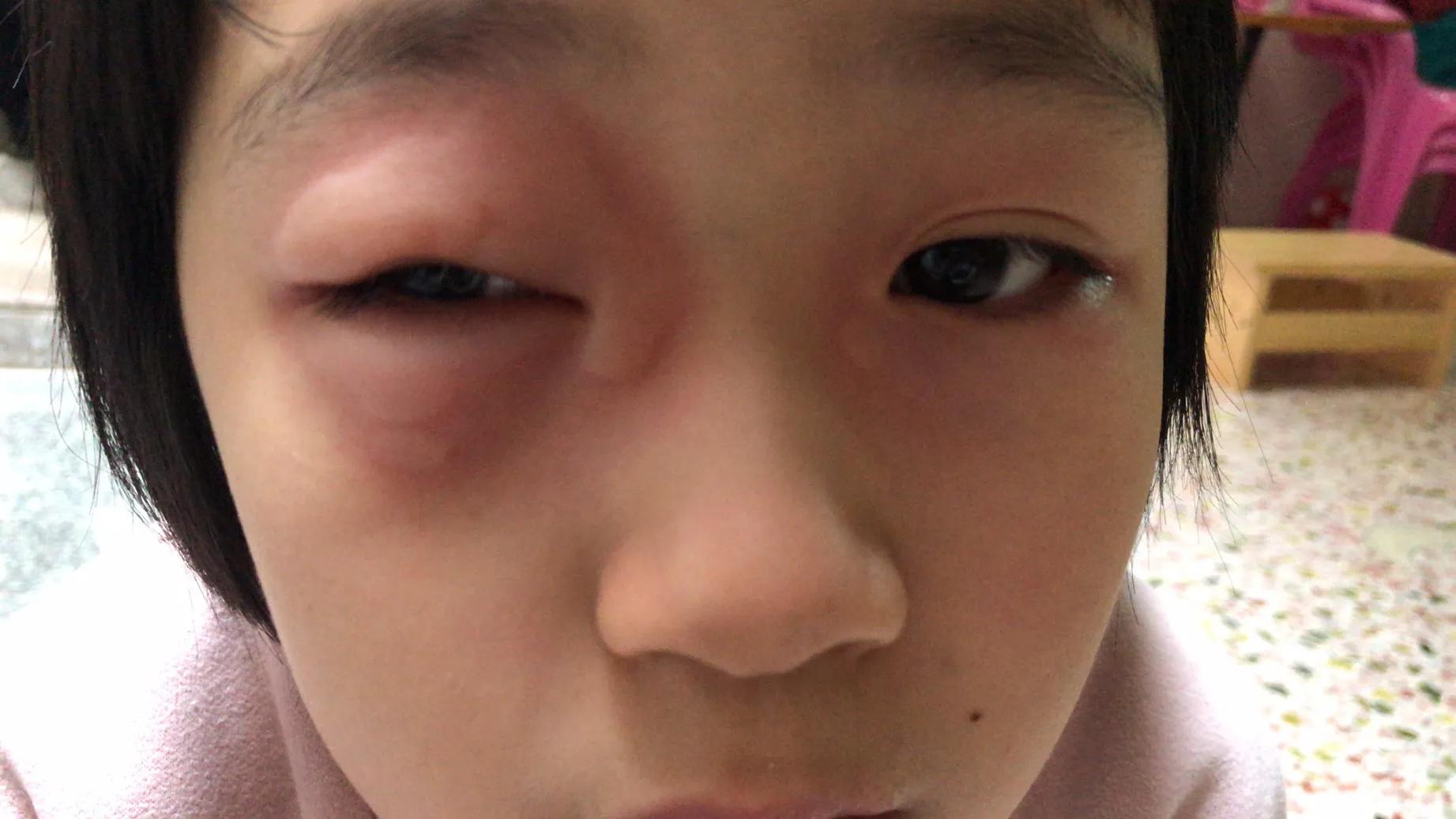 儿童发烧吃美林过敏什么原因,儿童发烧喝美林浑身起疙瘩