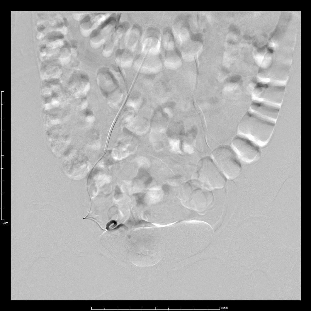 子宫腺肌症介入栓塞全国哪里好,子宫腺肌症介入栓塞治疗报销吗