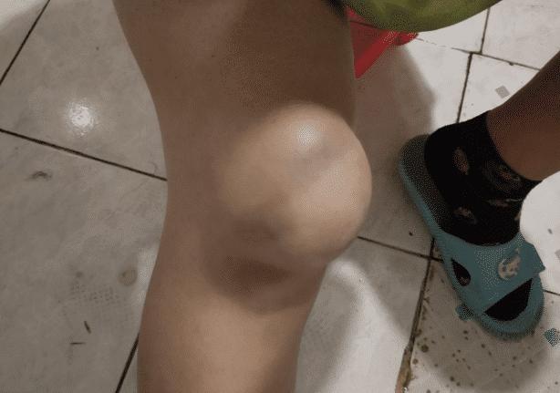 滑冰把膝盖内侧摔了怎么办,溜冰时膝盖磕破怎么办