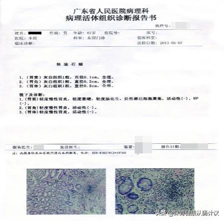 萎缩性胃炎你需要知道的5个点,萎缩性胃炎很吓人看完你就懂了