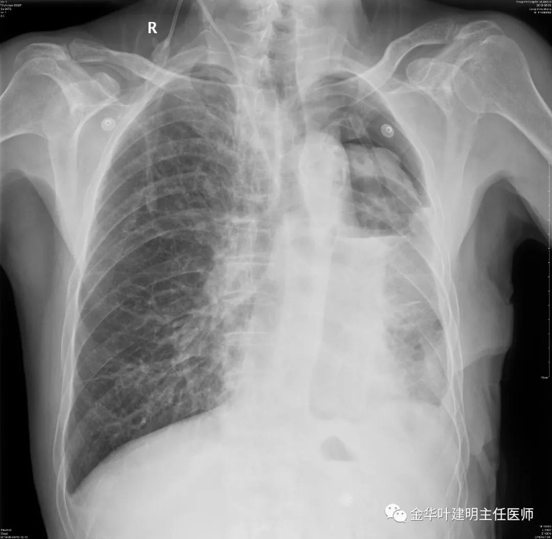 手术引起乳糜胸,有没有做了肺结节手术后是误诊的