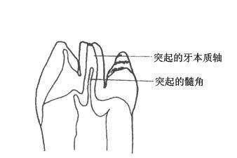 男童牙齿长在牙龈上,男童牙齿内壁长了一颗牙