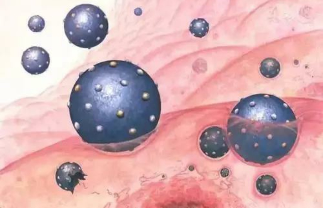 脑小血管病症状有哪些,专家讲解脑小血管病发病机制