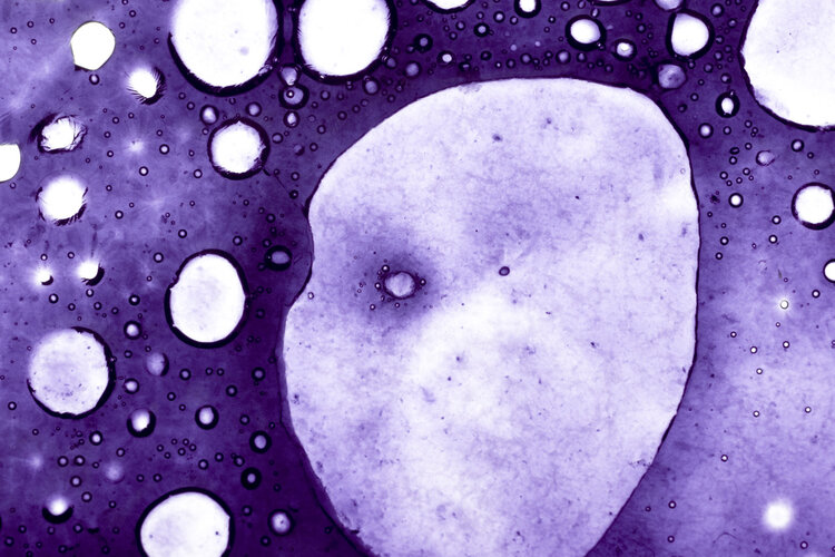 放射性粒子杀死癌细胞,粒子植入能把癌细胞杀死吗