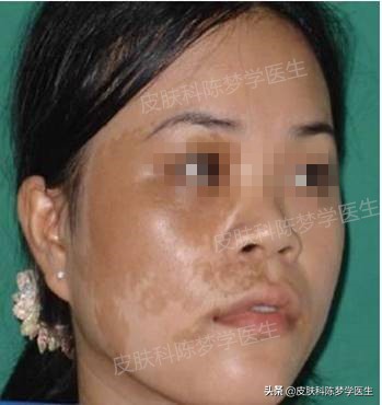 如何治疗脸上褐青色痣样斑,什么是褐青痣斑