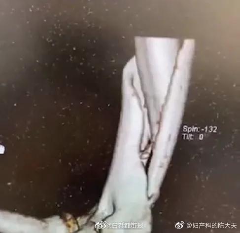 友情和骨头一起裂开！女生团建掰手腕骨折。怎样防止掰腕子骨折？