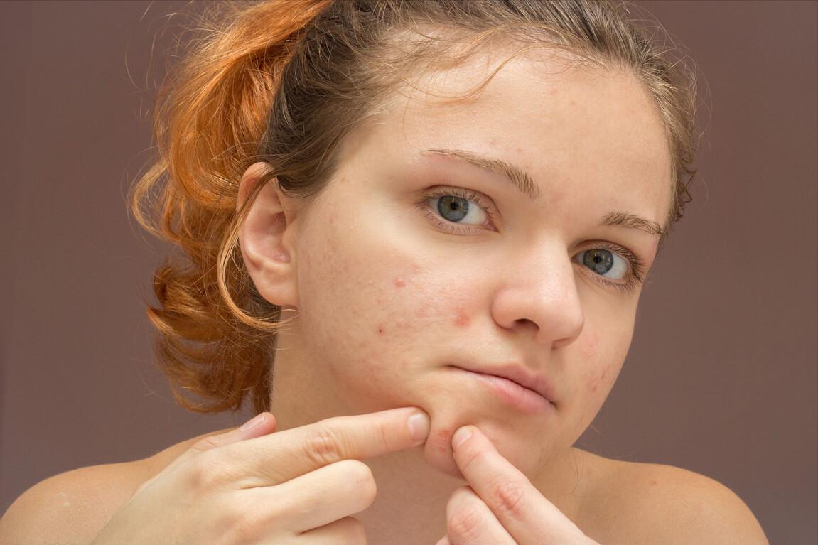 怎么去除痘印的黑色素,怎么去除痘印和闭口