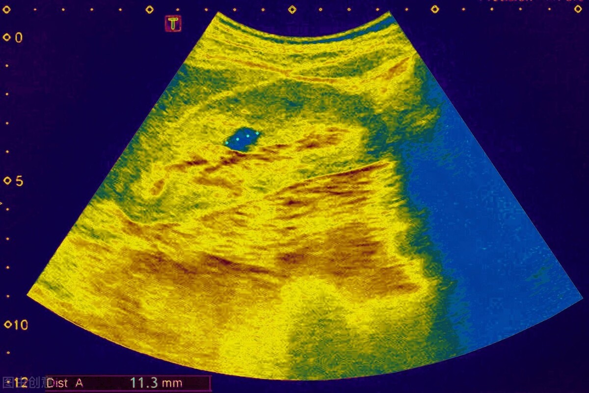 发现肾囊肿要怎么治疗好,体检发现肾囊肿怎么办