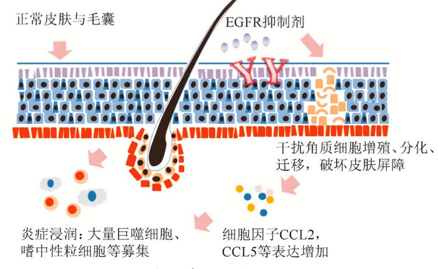 地舒单抗不良反应甲沟炎,皮肤免疫抑制剂治疗湿疹
