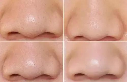 毛孔黑头去除神器小灯泡,吸黑头神器毛孔清洁仪器康佳