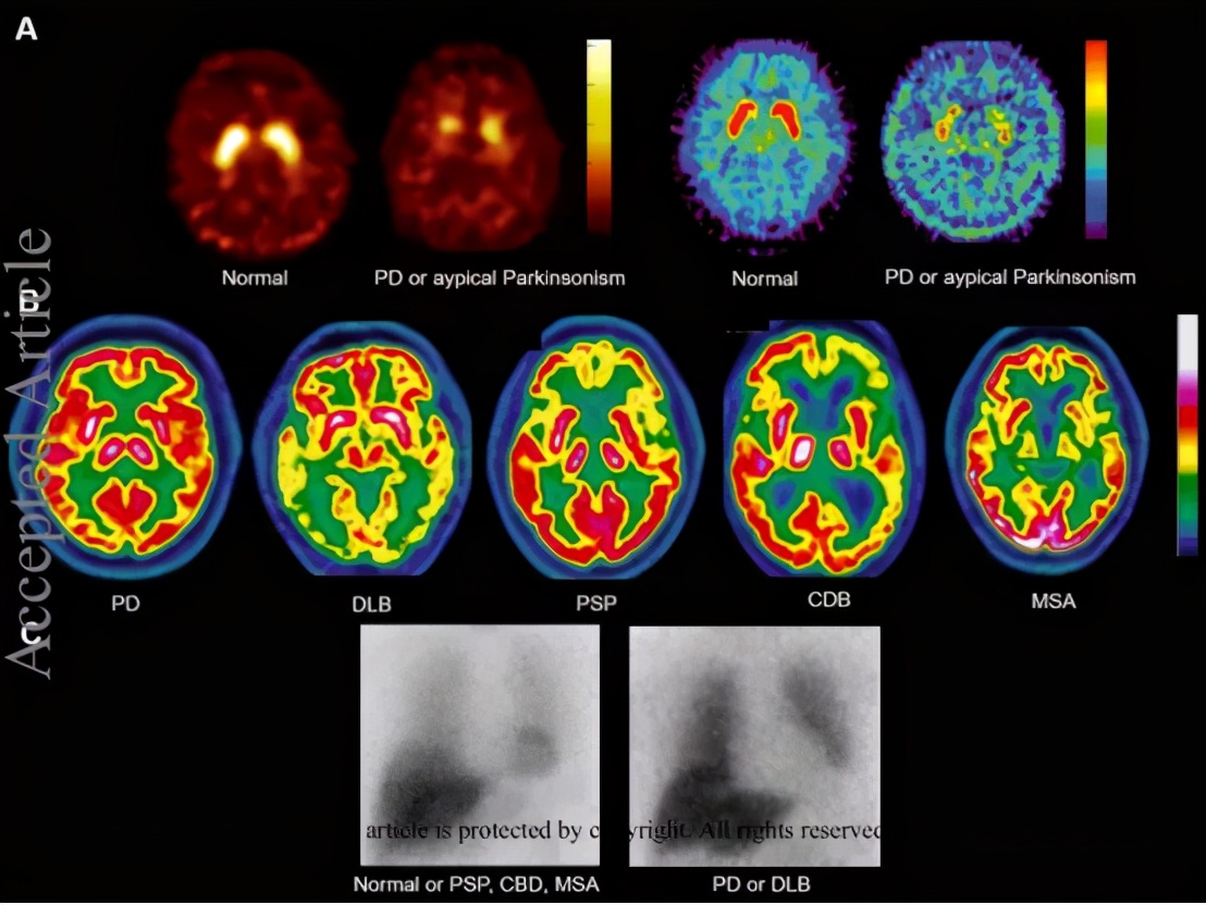 帕金森病的核磁共振影像反应,pet在帕金森病诊断中的意义