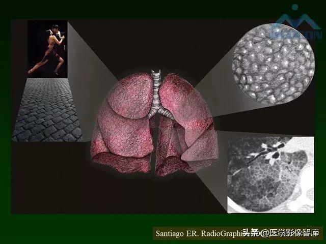 肺弥漫性网状影,两肺小叶间隔增厚可见网状模糊影