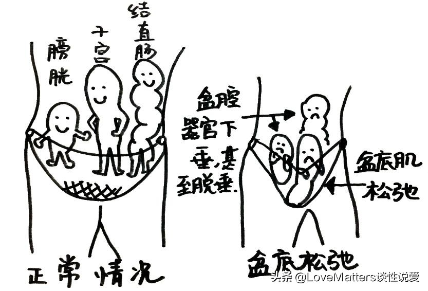 ella产后尿失禁案例,ella漏尿手术