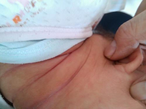 宝宝淹脖子推荐什么爽身粉,宝宝淹脖子爽身粉