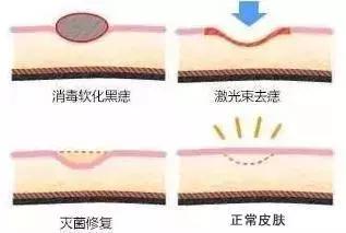 医生点痣,点痣医生