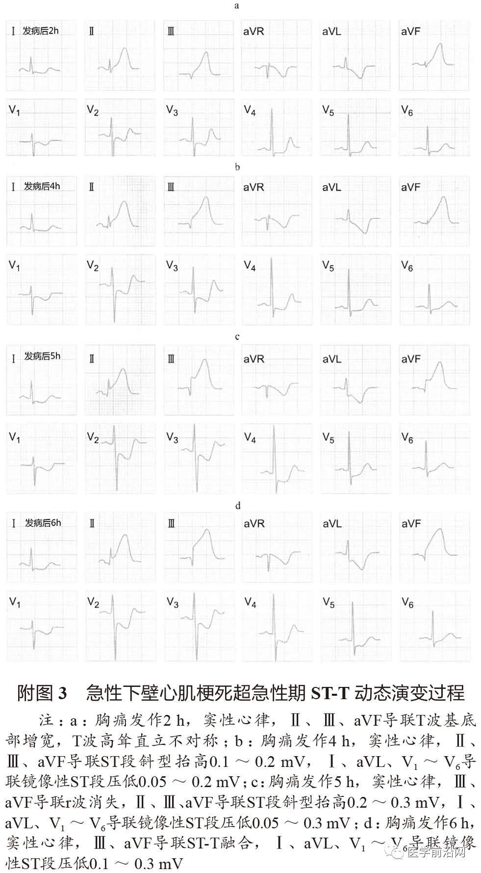 st抬高型心肌梗死溶栓时护理,急性st段抬高型心肌梗死治疗措施
