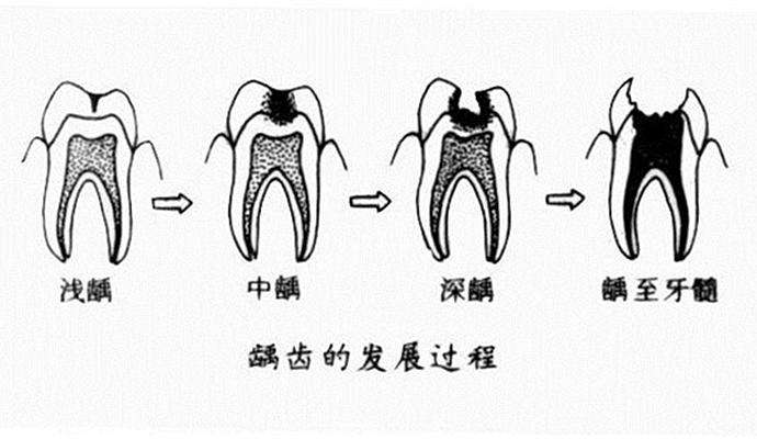 我的牙齿都掉了,牙齿烂掉一半可以直接补牙吗