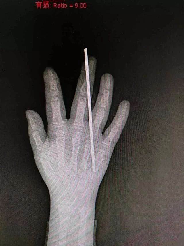 家中这些“杀手”一定要注意!2岁男孩腿上出现一凹陷的大洞