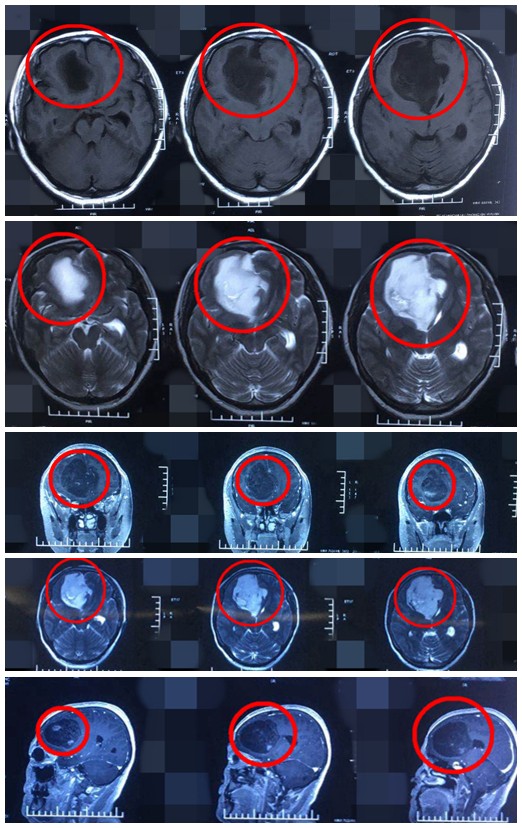 头疼脑ct检查发现脑肿瘤很准确,头痛十年查出来脑瘤