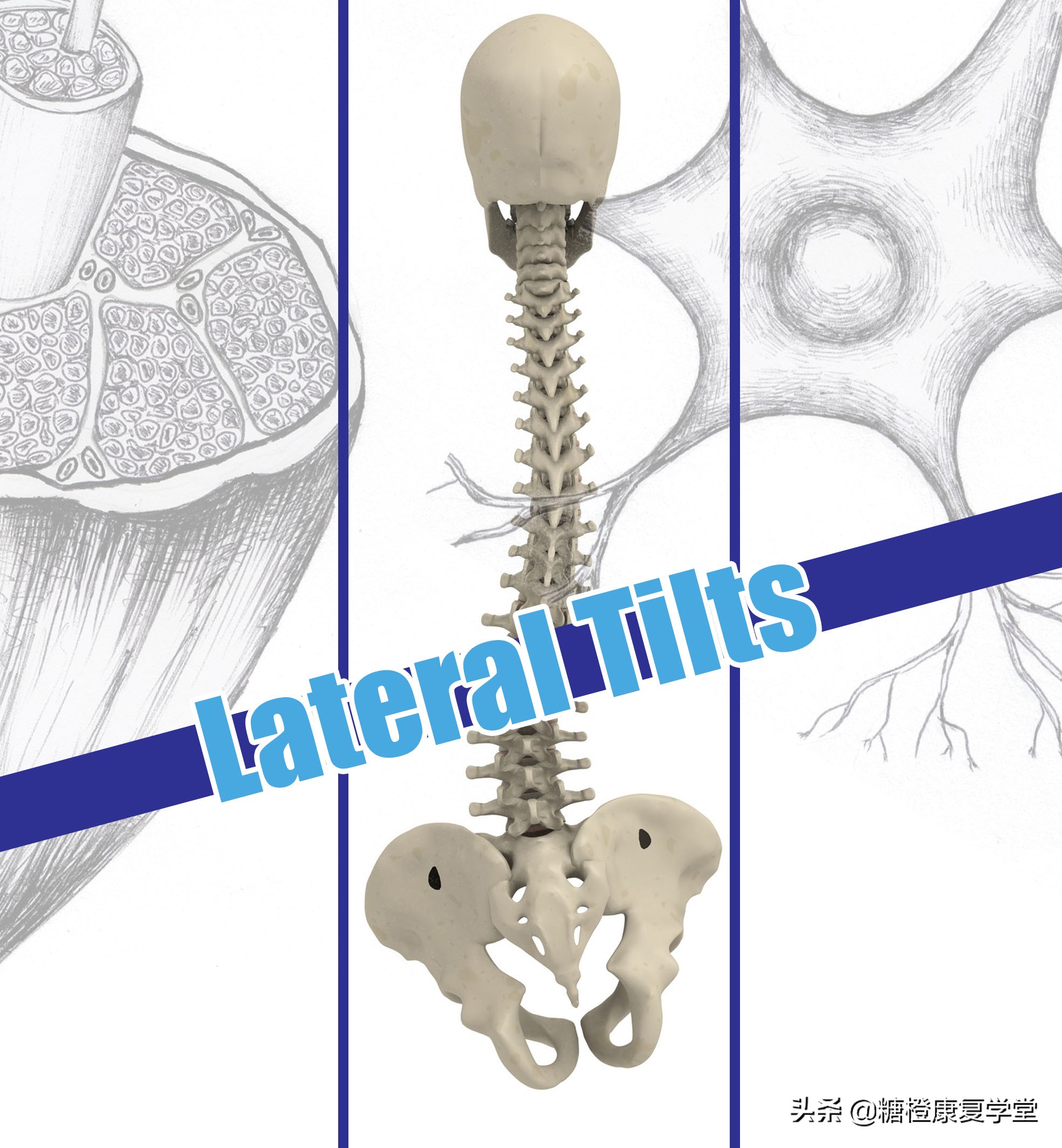骨盆倾斜与脊柱侧弯还有这种联系？（1）