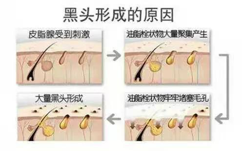 怎么解决糟心的黑头,怎么才能看清楚自己脸上的黑头