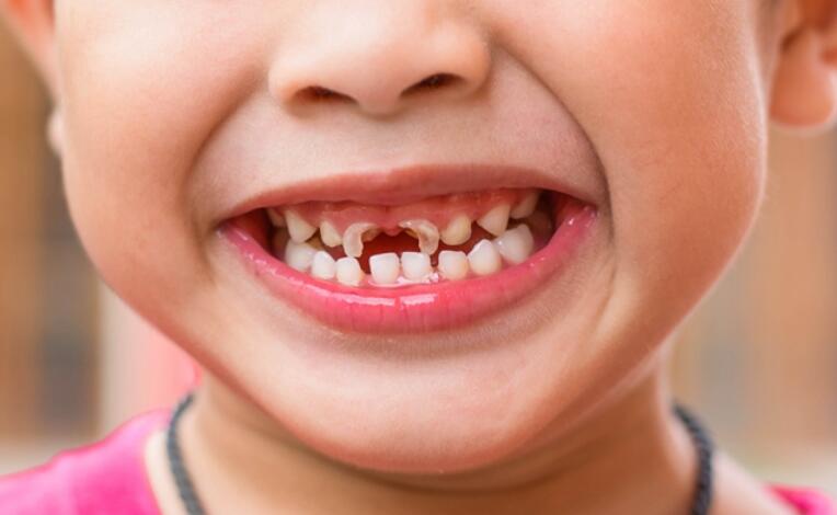 小孩换牙掉的牙齿扔哪里,孩子掉了上牙扔在哪里呢