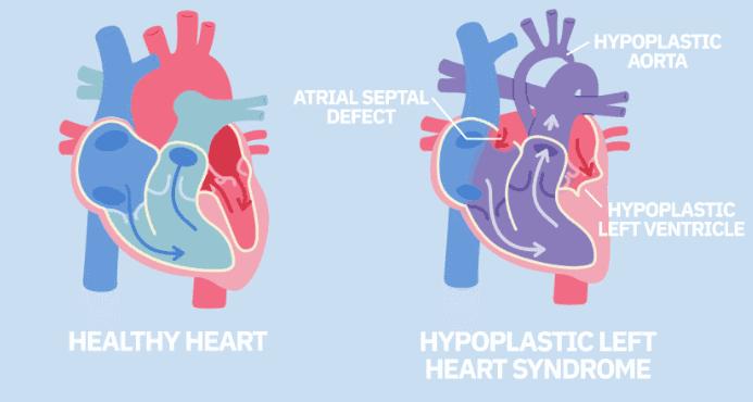 干细胞治疗心脏病最新研究进展,美国干细胞治疗中风研究最新消息