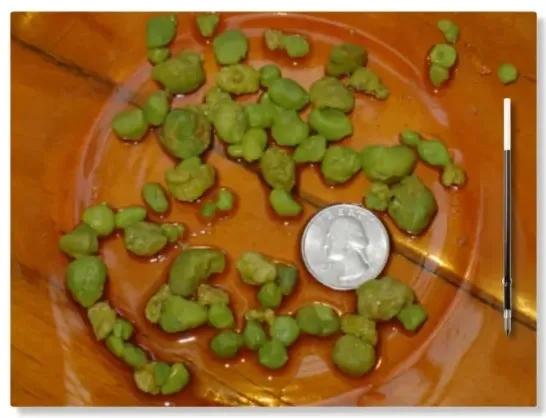 胆结石胆囊息肉不切除怎样治疗,胆囊息肉为什么不做保胆